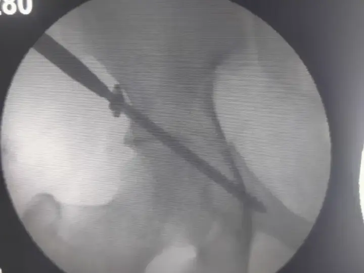 Acetabulum fracture — screw fixation