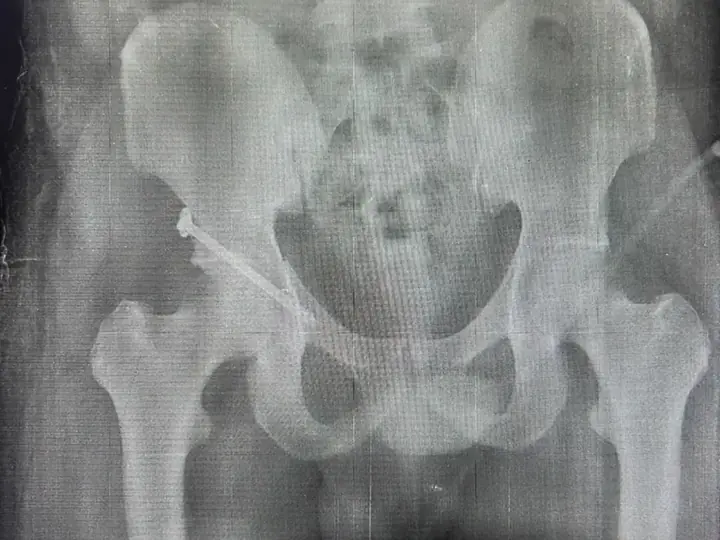 Acetabulum fracture surgery