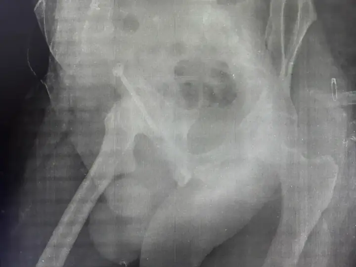 Acetabulum fracture surgery