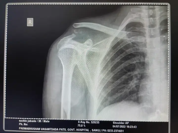 Lateral end clavicle fracture