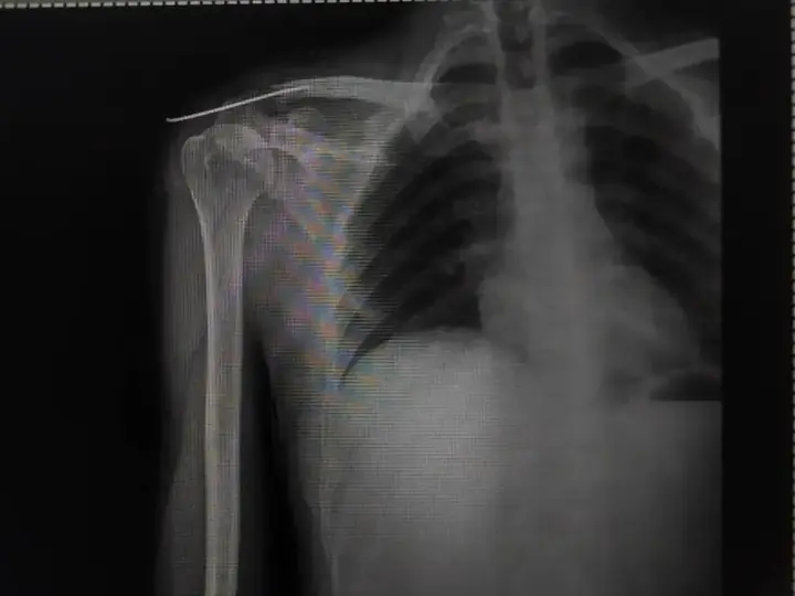 Clavicle fixation with K-wire