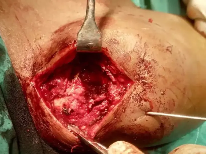Clavicle fracture repaired