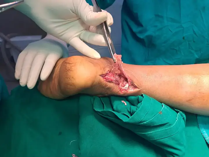 Tendoachilles complete rupture