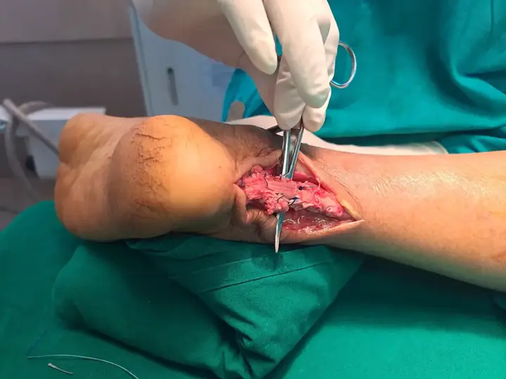 Tendoachilles repaired
