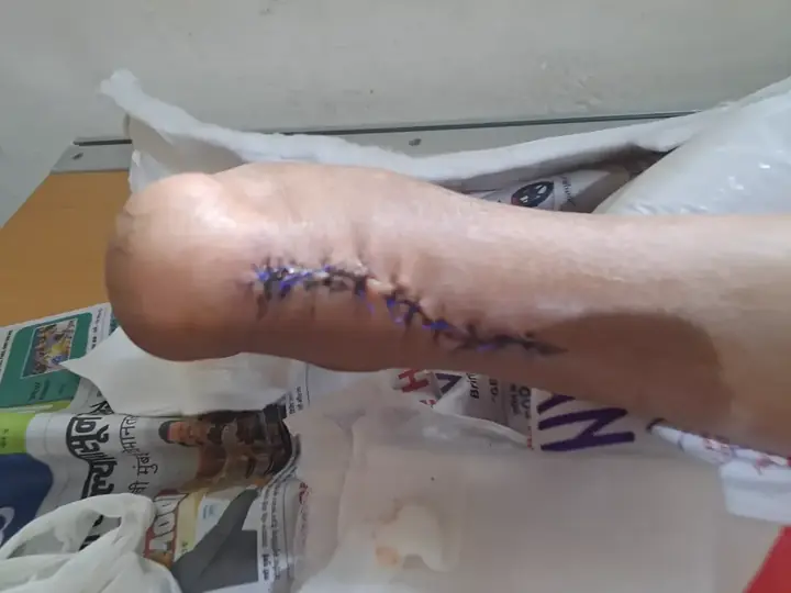 Wound healing after tendoachilles repair