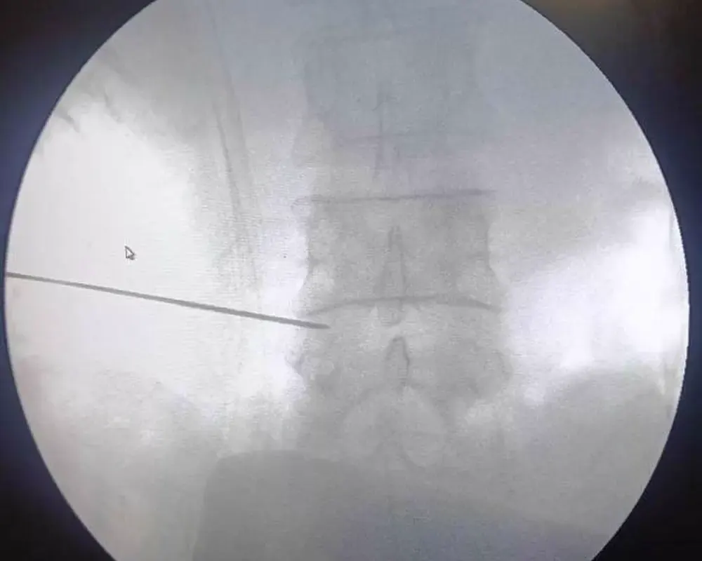 Pain-block injection under imaging