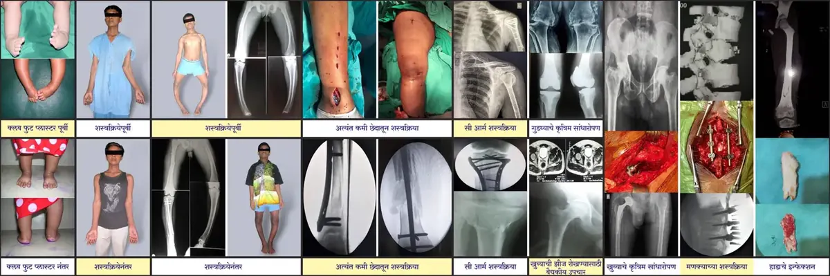 A collage of before-and-after orthopaedic cases treated at Galaxy Hospital, Sangli
