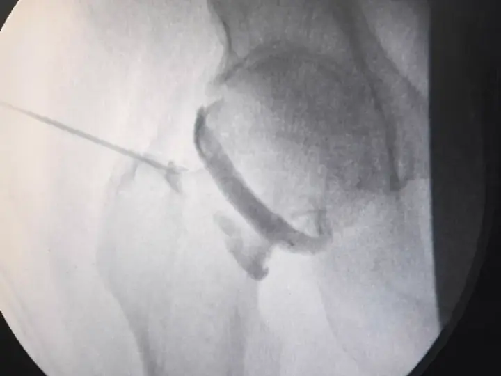 Hip ozone therapy procedure