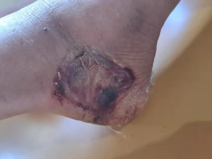 Ulcer healing with ozone therapy