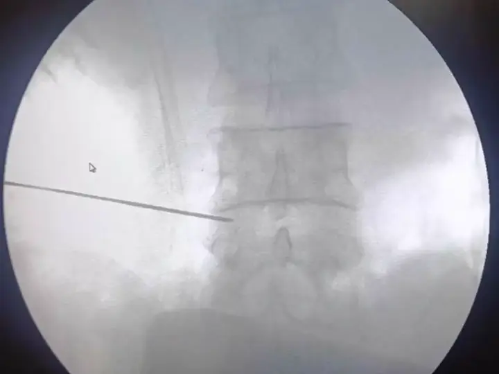 Nerve root injection for back pain