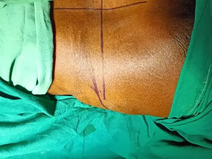 Nerve root block for back pain