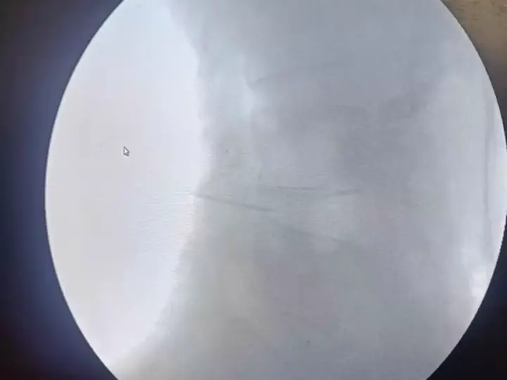 Nerve root block for back pain