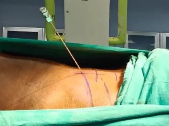 Needle placement under C-arm guidance