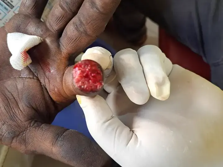 Fingertip injury repair