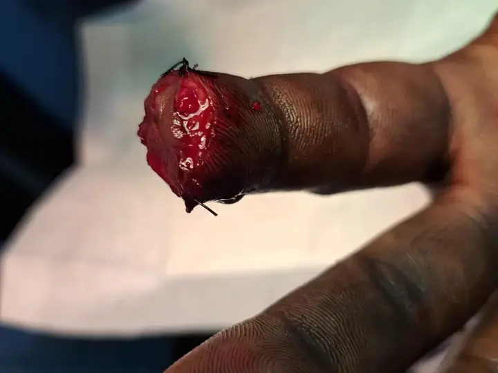 Fingertip injury repair