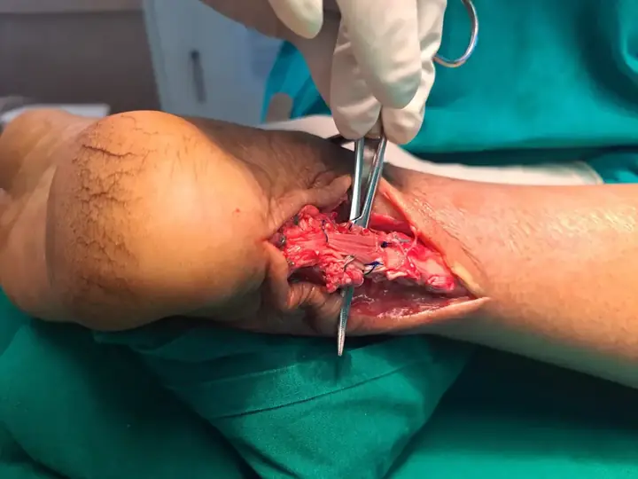 Tendoachilles rupture repair
