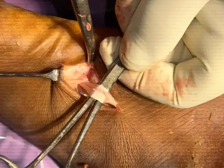 Tendoachilles rupture with peroneus tendon repair