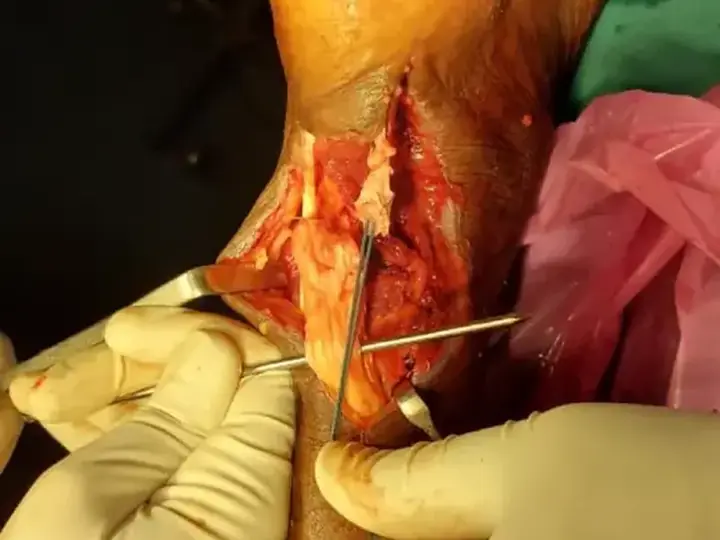 Tendoachilles rupture with peroneus tendon repair