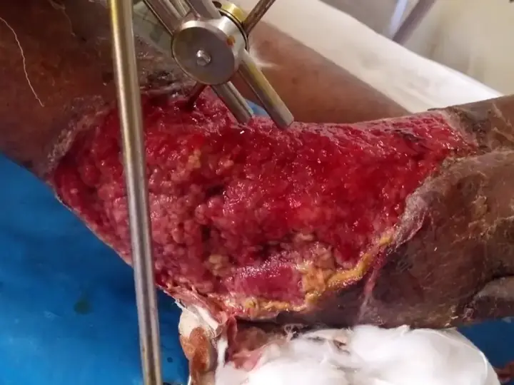 Split-thickness skin graft
