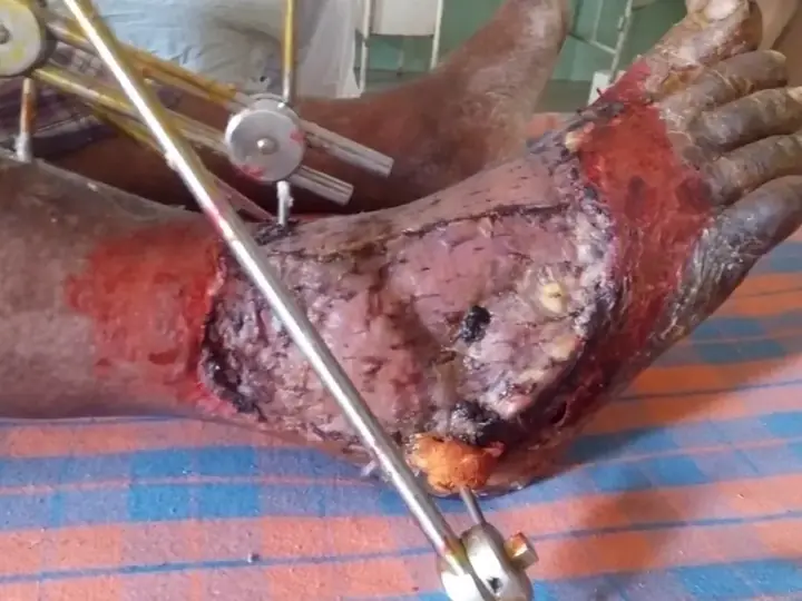 Split-thickness skin graft