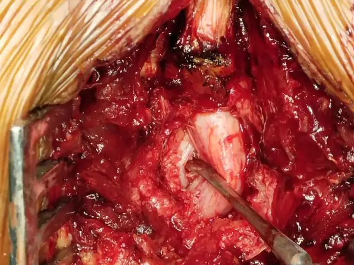 Discectomy