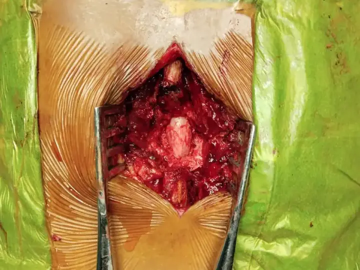 Discectomy