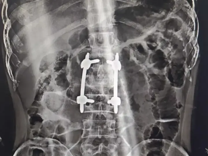 Spine fracture