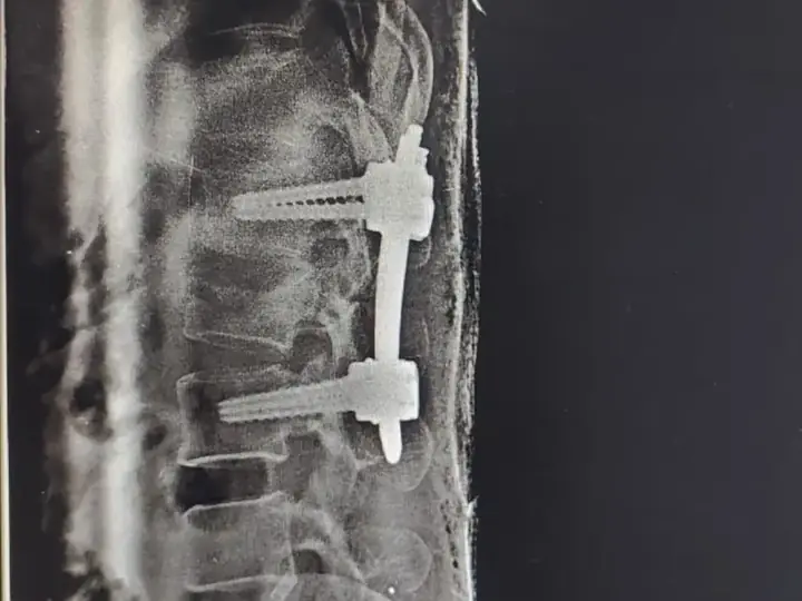 Spine fracture fixation