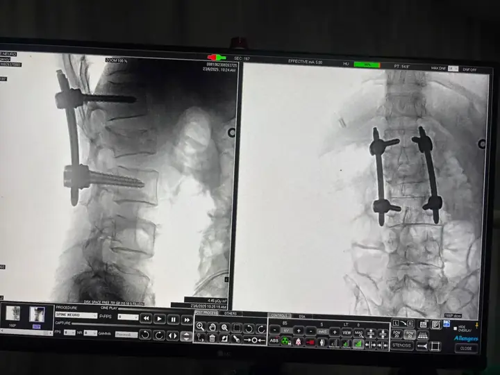 C-arm image during spine surgery