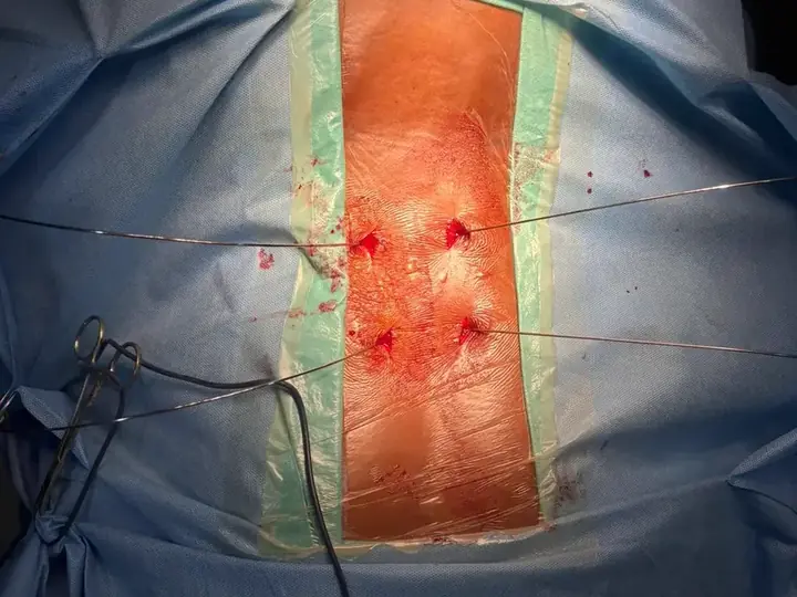Minimally invasive spine surgery