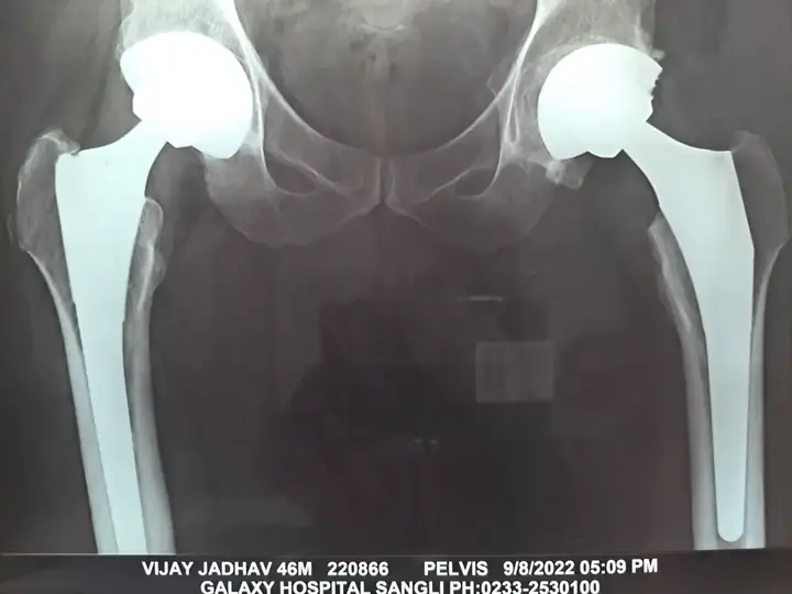 Total hip replacement