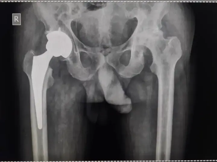 Total hip replacement X-ray