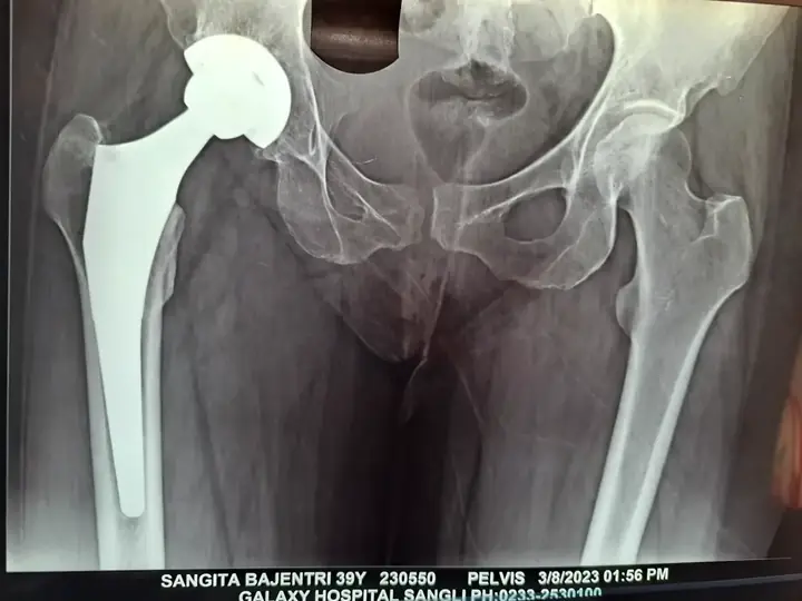Uni hip replacement