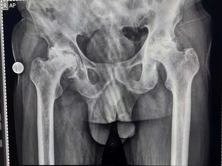 Hip replacement — pre-operative X-ray