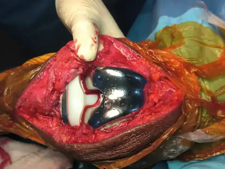 Total knee replacement