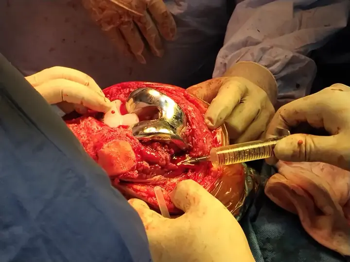 Total knee replacement X-ray