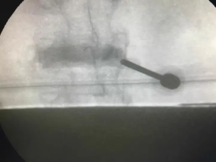 Vertebroplasty