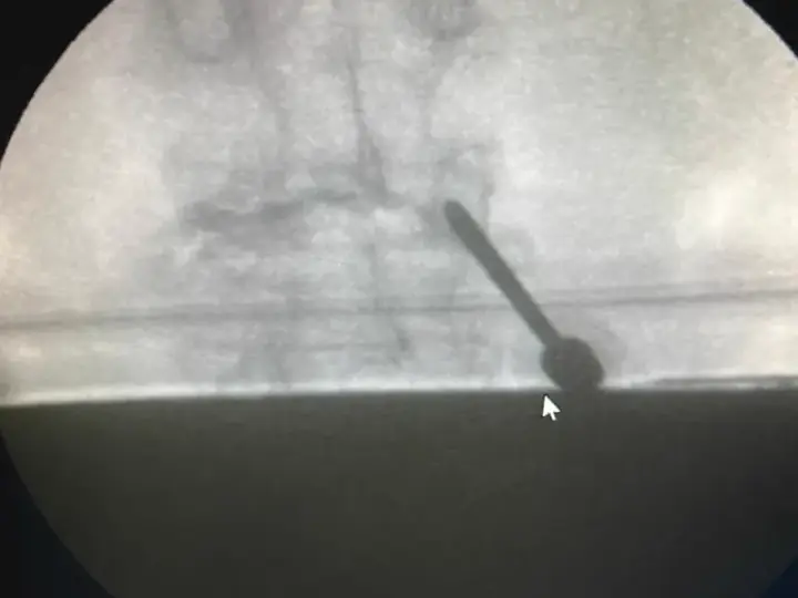 Vertebroplasty