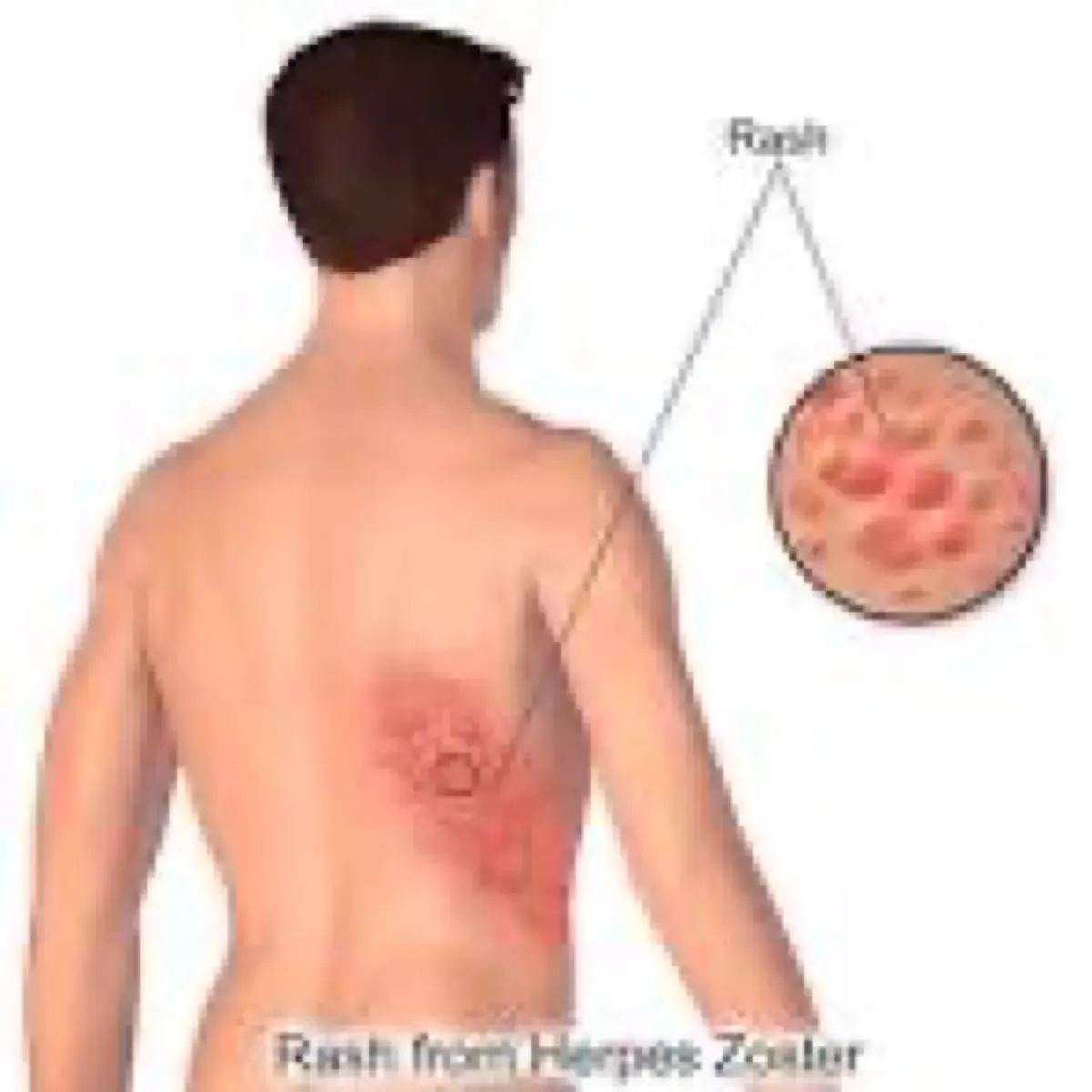 Post-herpetic neuralgia pain-block treatment
